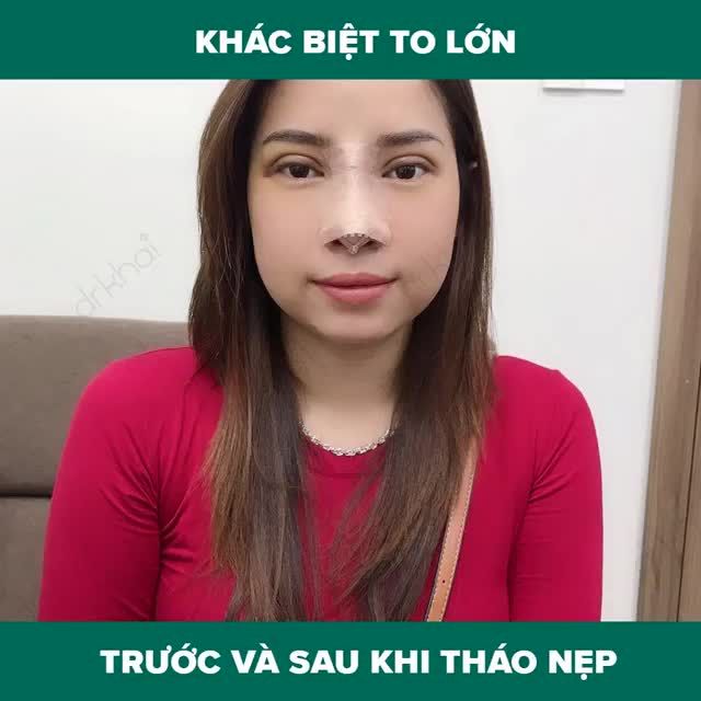 KHÁC BIỆT TO LỚN TRƯỚC VÀ SAU KHI THÁO NẸP