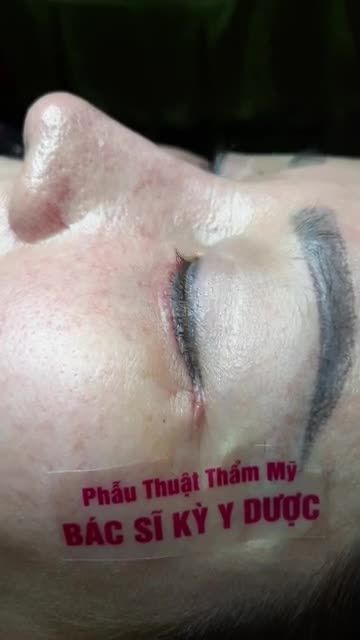NÂNG MŨI SAU 1 NĂM CẮT BỎ DA DƯ MI DƯỚI, TRẺ HOÁ VÙNG DA MI DƯỚI SAU 10 NGÀY