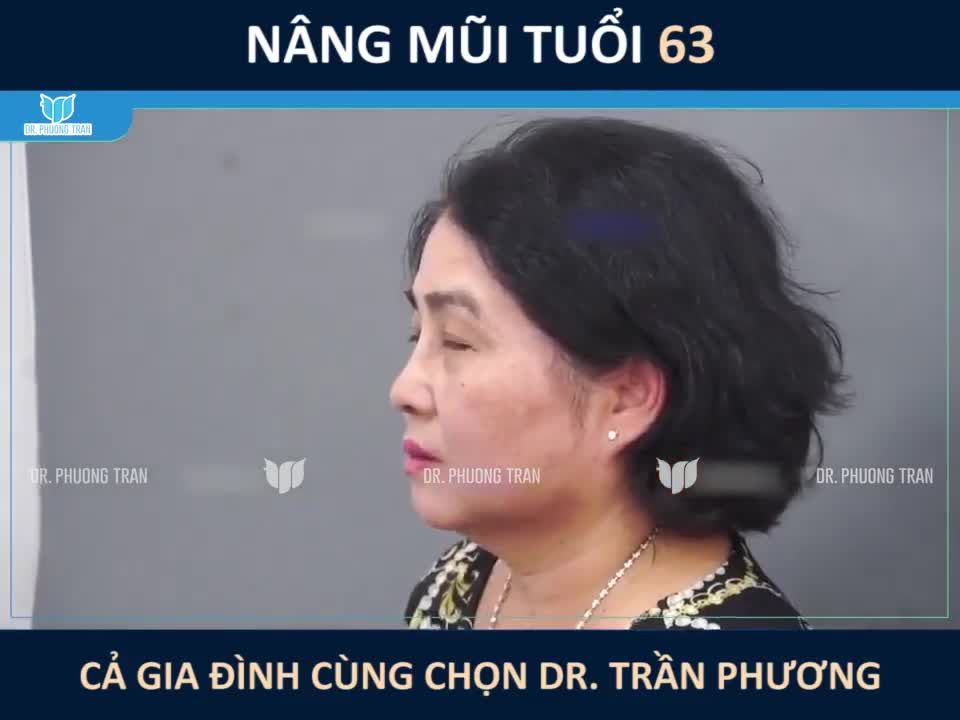 NÂNG MŨI Ở TUỔI 63. TẠI SAO KHÔNG?
