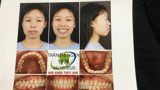 Niềng răng tại Nha Khoa Thùy Anh