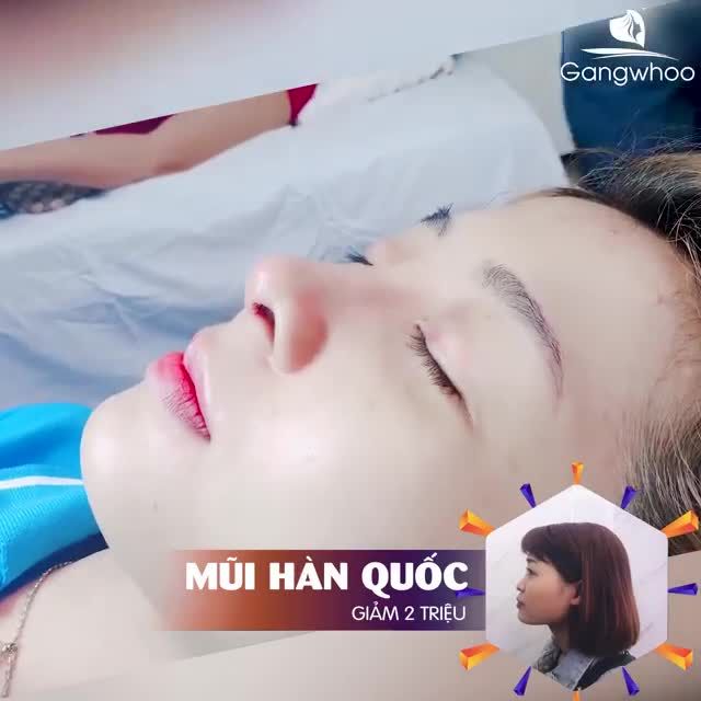 TÁI KHÁM THÁO NẸP NÂNG MŨI HÀN QUỐC 10 NGÀY - ĐẸP MÊ HỒN