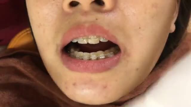 BUNG LỤA CHO KHÁCH HÀNG RĂNG HÔ - KHẤP KHỂNH