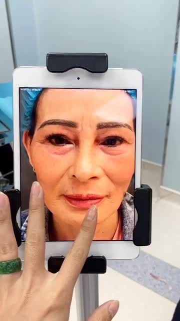 Giải cứu ca mũi hỏng cho vị khách hàng U60