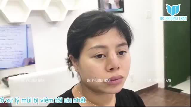 BÁC SĨ PHÂN TÍCH PHÁC ĐỒ XỬ LÝ MŨI BỊ VIÊM TỐI ƯU NHẤT