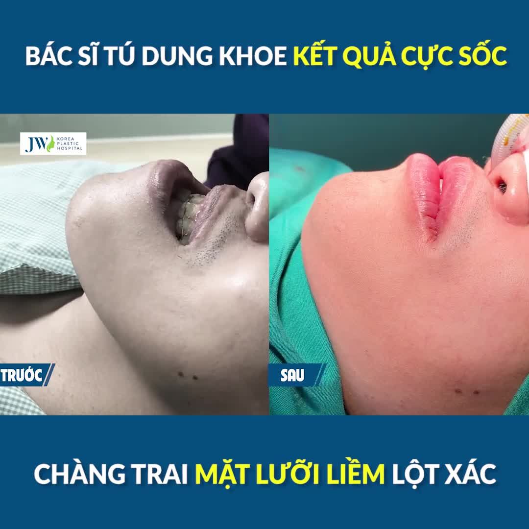 Bác sĩ Tú Dung khoe KẾT QUẢ CỰC SỐC, MẶT LƯỠI LIỀM lột xác