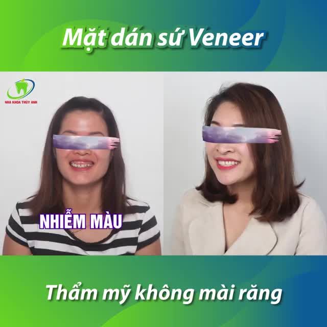 MẶT DÁN SỨ VENEER - GIẢI PHÁP THẨM MỸ RĂNG KHÔNG MÀI RĂNG