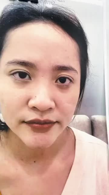 Sóng mũi thấp - đầu mũi cụp - cánh mũi bè