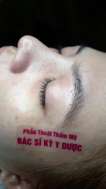 TÁI KHÁM NÂNG MŨI SAU 6 THÁNG