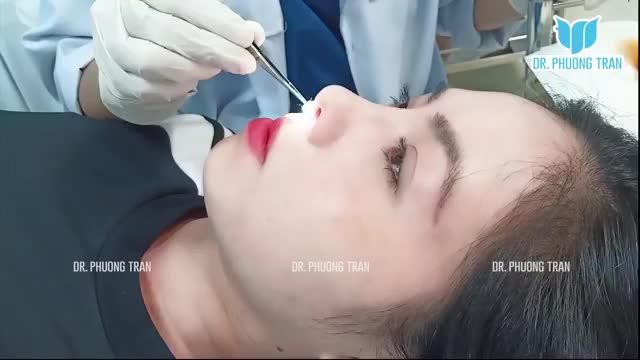 THAY ĐỔI "NGOẠN MỤC CHỈ SAU 14 NGÀY NÂNG MŨI CẤU TRÚC SỤN SƯỜN