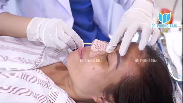 1 TUẦN SAU NÂNG MŨI CẤU TRÚC SỤN SƯỜN TOÀN PHẦN