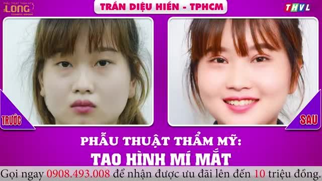 Căt Mí Plasma - Cho Đôi Mắt Kiêu Sa