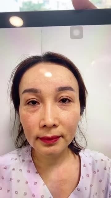 Dáng mũi sửa lại mới 15 đã lên form cực kì đẹp và chuẩn dáng mũi tự nhiên đáp ứng được đúng nhu cầu của khách hàng