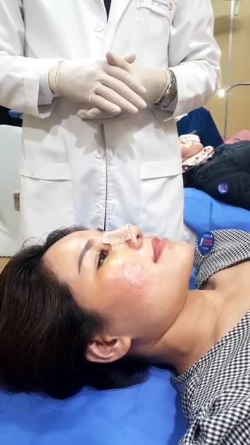 Khách hàng thực hiện dịch vụ Nânh mũi Cấu Trúc 4D kết hợp chỉnh xương thay nẹp sau 5 ngày