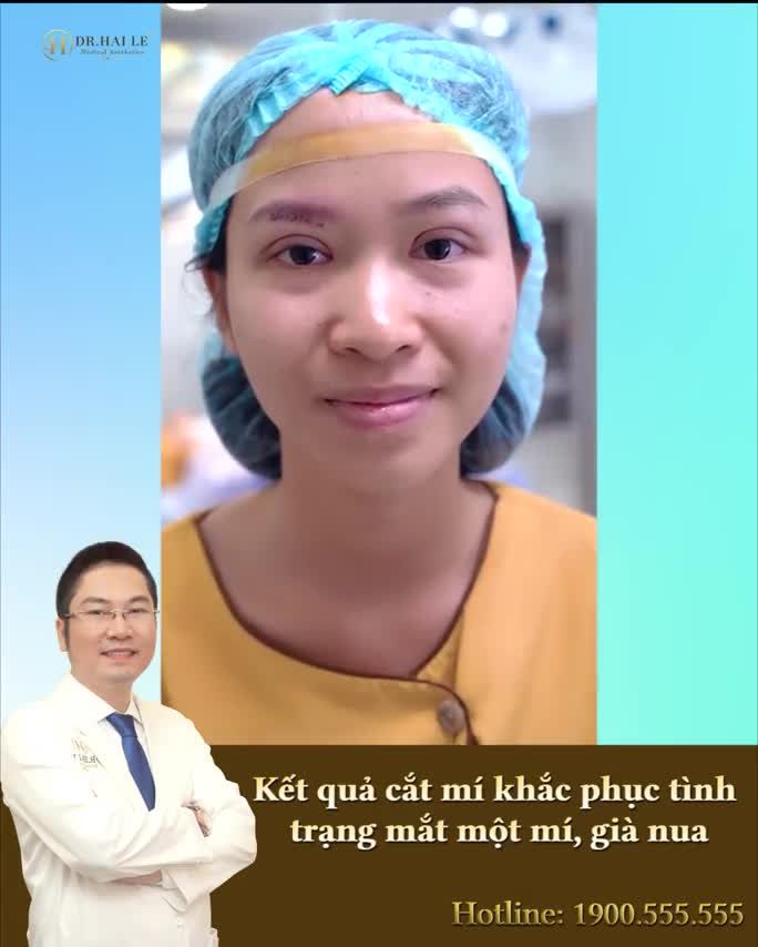 MẮT BẠN MỘT MÍ, SỤP MÍ LỰA CHỌN ĐÁNG TIỀN NHẤT LÀ CẮT MÍ THẨM MỸ TẠI DR.HẢI LÊ.!!