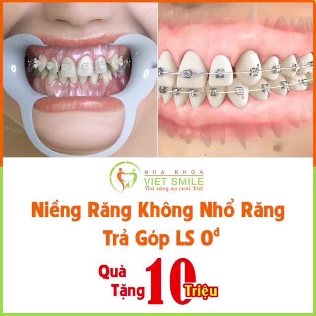Niềng răng không nhổ răng – Trả góp lãi suất 0đ