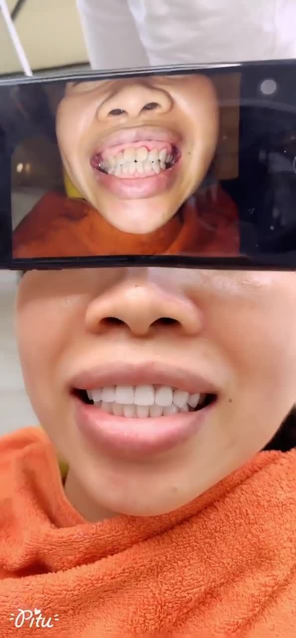 Sự thay đổi hoàn toàn sau khi làm răng sứ thẩm Mỹ tại nha khoa xs dental.