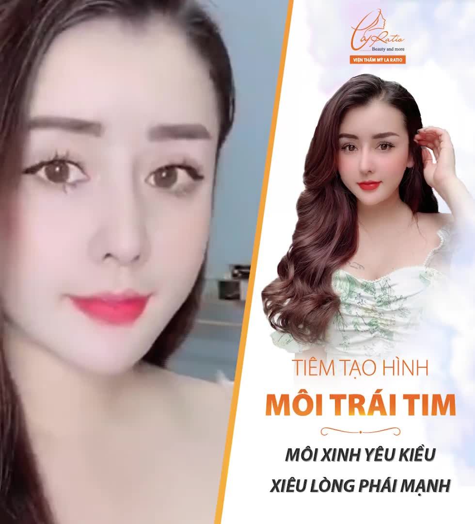 TIÊM TẠO HÌNH MÔI TRÁI TIM MÔI XINH YÊU KIỀU – XIÊU LÒNG PHÁI MẠNH