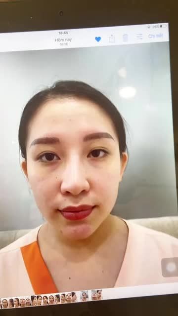 Vì sao da mũi mỏng nên nâng mũi cấu trúc Surgiform?
