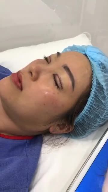 Kết quả ngay sau khi Cắt mí trên plasma tại Bv Thẩm mỹ Kangnam- tươi trẻ tức thì