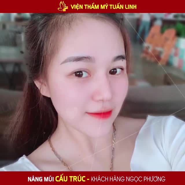 Khác hàng Ngọc Phương - Nâng mũi cấu trúc nhà Tuấn Linh  XINH LUNG LINH LUÔN NAZZZZ