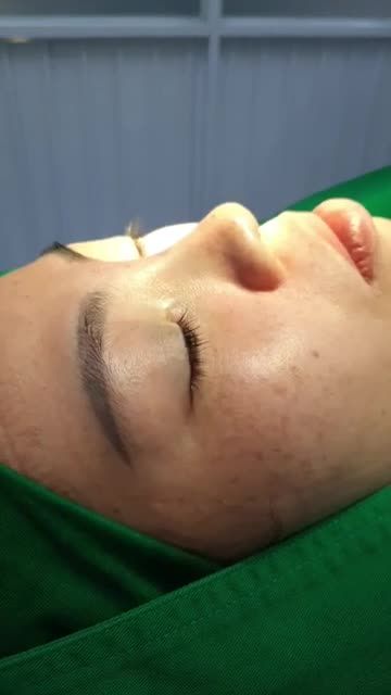 NÂNG MŨI BÁN CẤU TRÚC SỤN TAI ĐA LỚP