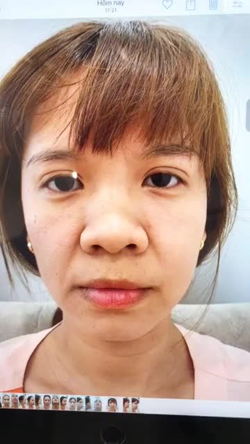Sóng mũi thấp võng - mô đầu mũi to bè - cánh mũi dày