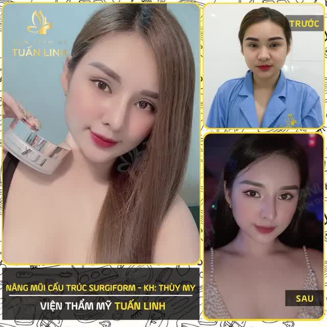 Khách hàng Thùy My - Nâng mũi cấu trúc Surgiform nhà  Tuấn Linh  XINH, SANG lên RẤT NHIỀU nazzz