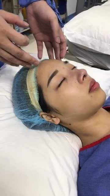 Quá trình nẹp mũi cho kh Nâng mũi Cấu trúc 4D Chỉnh xương tại bệnh viện Thẩm mỹ Kangnam