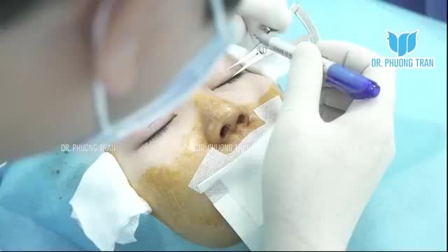 CẬN CẢNH KỸ THUẬT CẮT MÍ MẮT, TẠO MÍ ĐÔI ĐỀU ĐẸP TỰ NHIÊN
