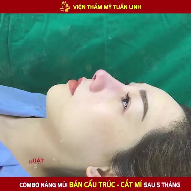 Combo Nâng mũi bán cấu trúc + Cắt mí Đã giúp khuôn mặt bạn XINH ĐẸP RẠNG NGỜI hơn BỘI PHẦN nazzzz.