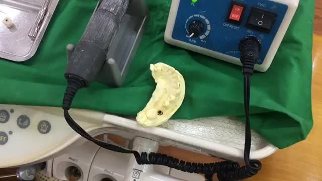 Lắp răng implant phục hình răng 46 bị mất cho anh khách hàng tại Nha Khoa Thuỳ Anh.
