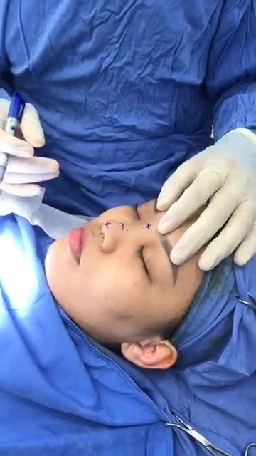 Phân tích Nâng mũi Cấu trúc 4D tại bệnh viện Thẩm mỹ Kangnam