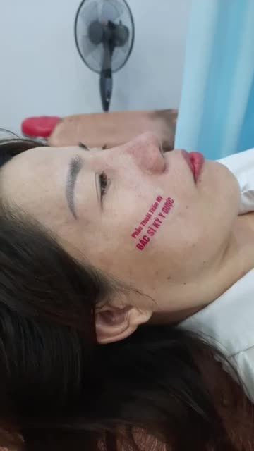 TÁI KHÁM NÂNG MŨI SAU 10 NGÀY TẠI BÁC SĨ KỲ Y DƯỢC