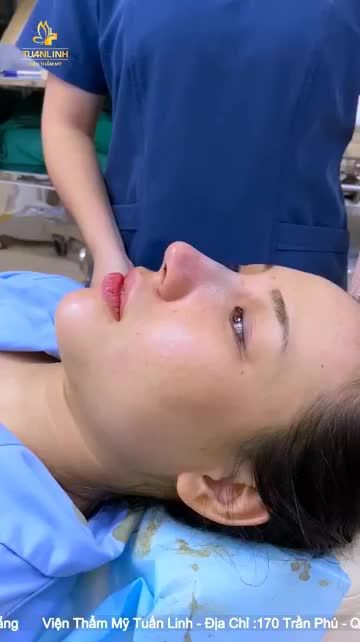 Case Nâng mũi + Độn cằm vừa xong tại Tuấn Linh đây ạ