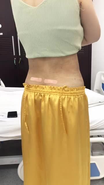 Khách hàng làm dịch vụ lipo bụng eo sau 2 ngày phẫu thuật