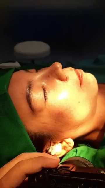 NÂNG MŨI BÁN CẤU TRÚC SỤN TAI ĐA LỚP CUỘN CÁNH MŨI PLASMA