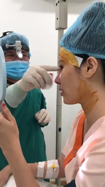 Ca nâng mũi cấu trúc cho khách hàng từng tháo sóng sau 2 năm