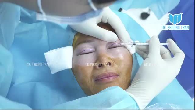 CẬN CẢNH KỸ THUẬT CẮT MÍ MẮT TRÊN