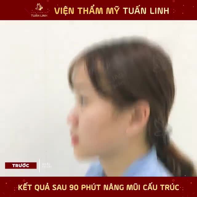 CLIP REVIEW NÂNG MŨI CẤU TRÚC SAU 90 PHÚT !!!