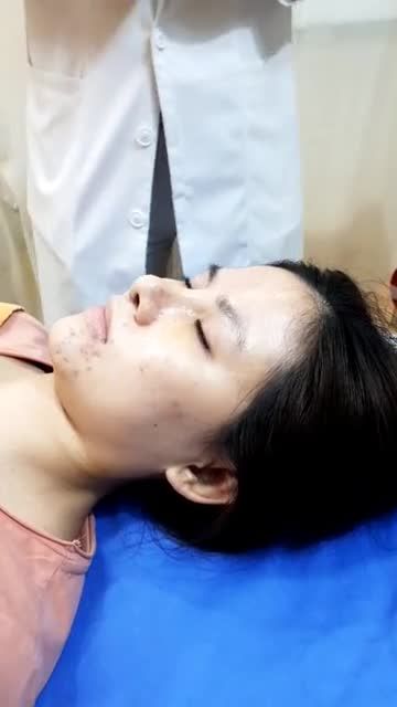 Khách hàng nâng mũi cấu trúc sline 4D chỉnh xương, cắt cánh sau 5 ngày thay nẹp mũi.