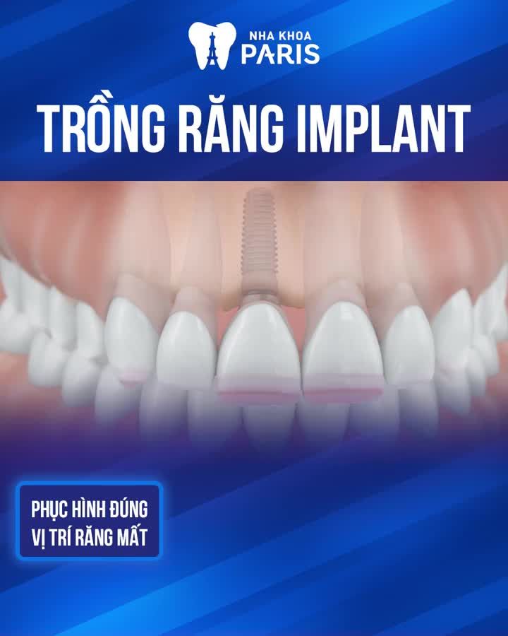 MẤT RĂNG - CHỌN TRỤ IMPLANT HAY CẦU RĂNG SỨ?