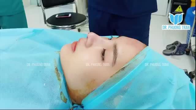 SIÊU PHẨM MŨI CẤU TRÚC VỪA XONG