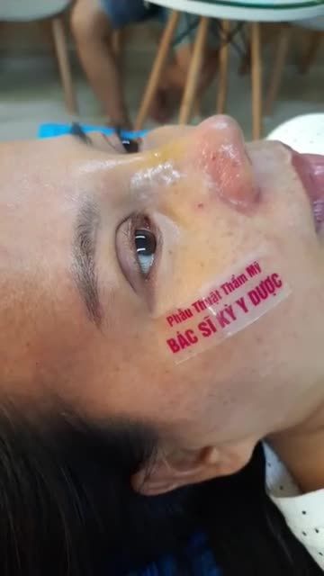 NÂNG MŨI BÁN CẤU TRÚC SỤN TAI VÀ CUỘN CÁNH MŨI PLASMA SAU 10 ngày