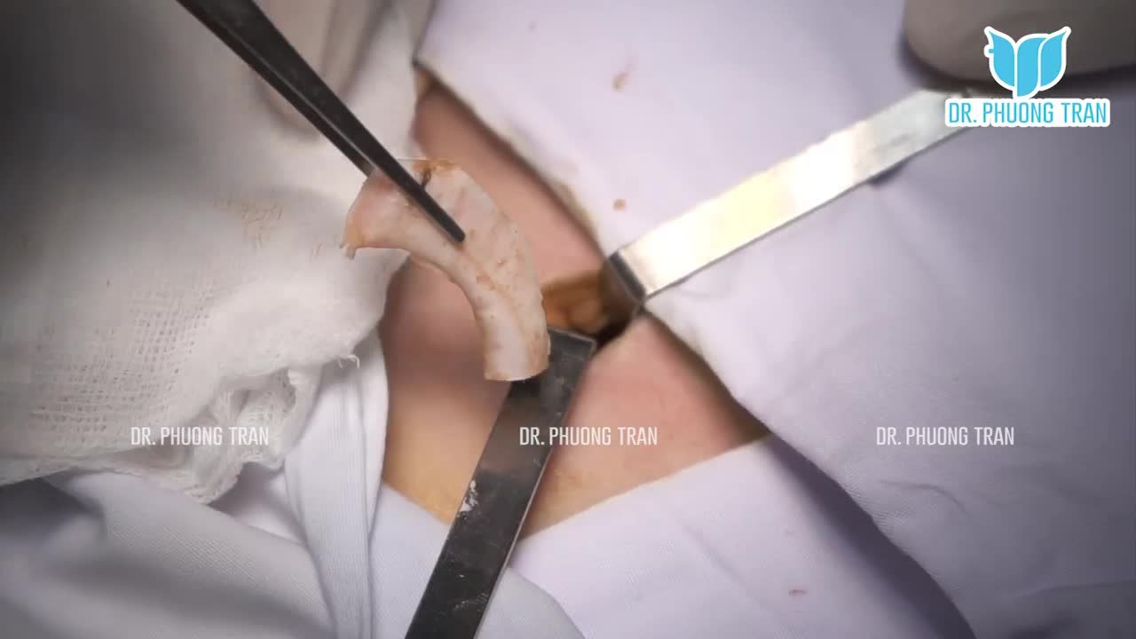 NÂNG MŨI SỤN SƯỜN TỰ THÂN, NÓI KHÔNG VỚI VIÊM NHIỄM, DỊ ỨNG VÀ ĐÀO THẢI CHẤT LIỆU