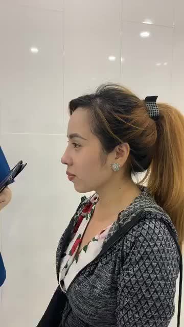 TÁI KHÁM SAU 1 THÁNG NÂNG MŨI CẤU TRÚC TẠI TUẤN LINH
