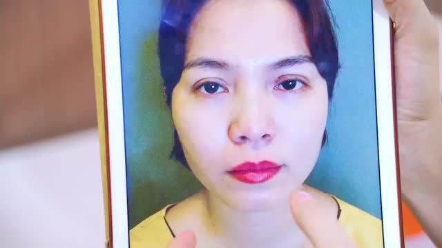 Bác sĩ làm việc xuyên trưa giải cứu thành công ca Mí lỗi hỏng khắc phục hoàn toàn khuyết điểm và biến chứng nhờ vào kỹ thuật sửa mí Deeptech20