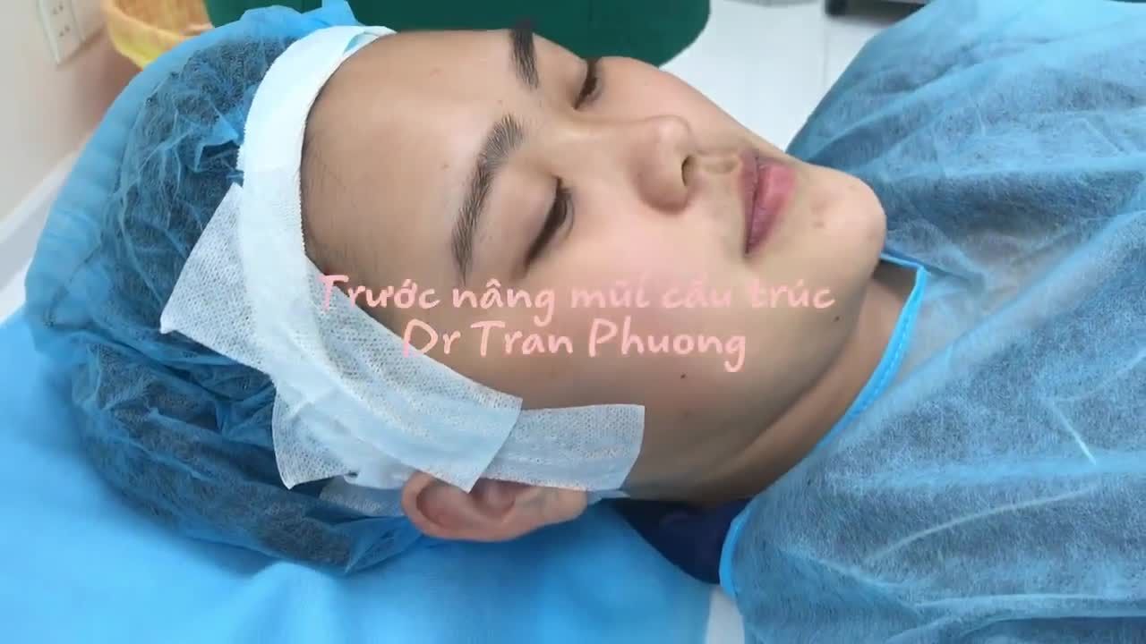 Chỉ với 35tr sẽ có một sự sang trọng rất nhiều sau khi phẫu thuật mũi.