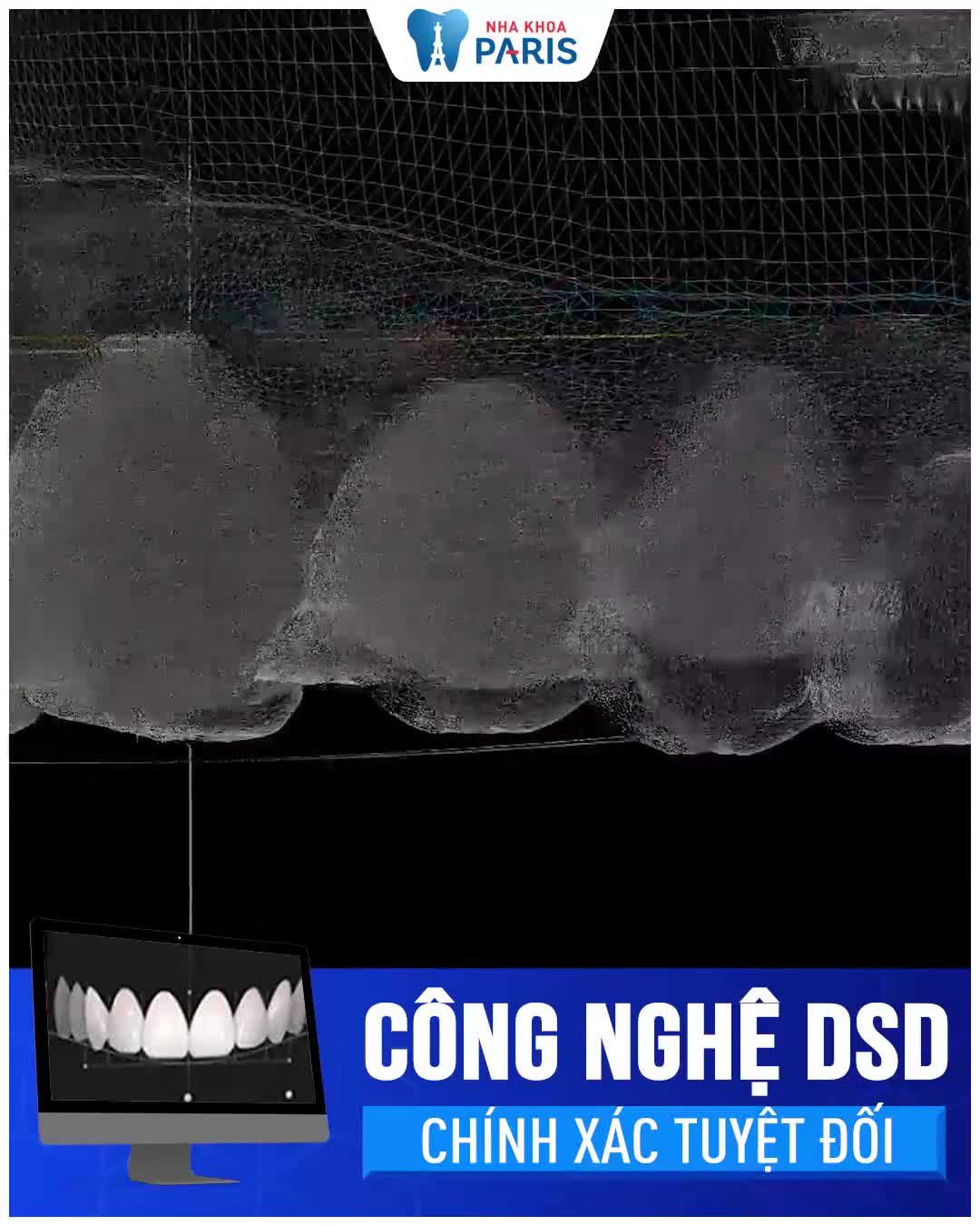 Công nghệ Bọc sứ Nano 5S - Đỉnh cao phục hình răng thẩm mỹ