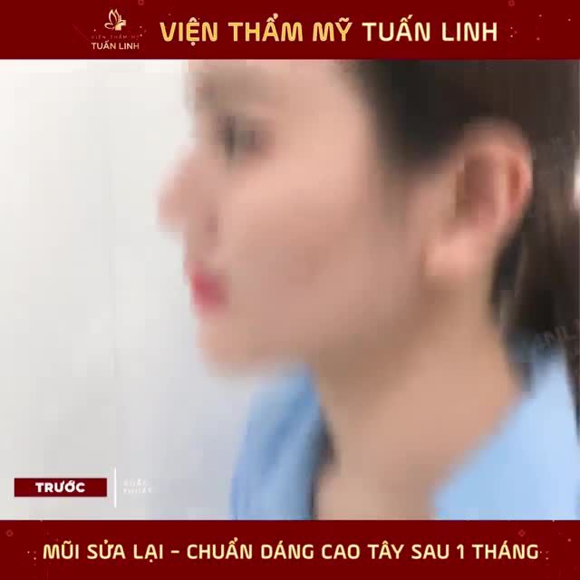 NÂNG MŨI TÁI CẤU TRÚC - KHẮC TINH CỦA CÁC DÁNG MŨI HỎNG