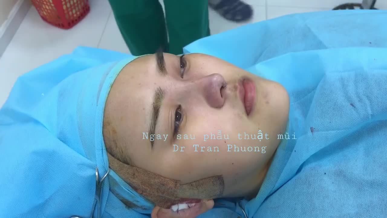 Kết quả ngay sau phẫu thuật mũi cấu trúc ở clip liền trước.